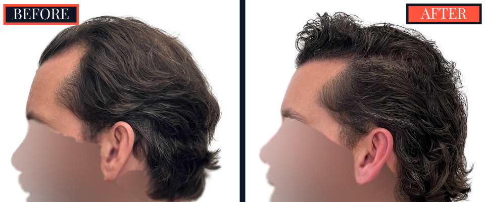 3111 graft FUE hair Transplant - 1 YR post-op