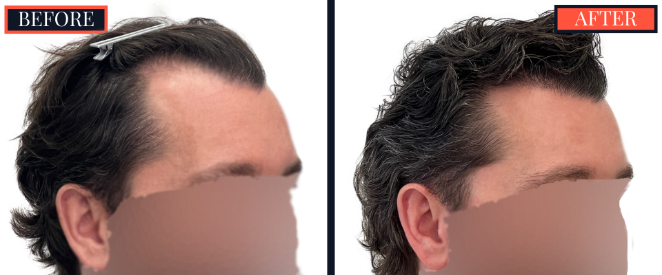 3111 graft FUE hair Transplant - 1 YR post-op