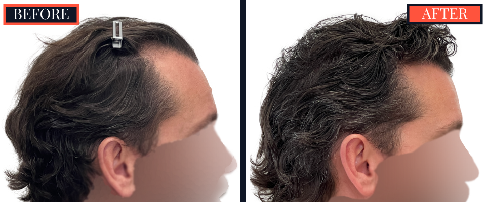3111 graft FUE hair Transplant - 1 YR post-op
