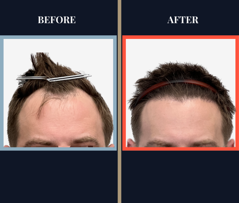 FUE Hair Transplant Results - 1836 Grafts