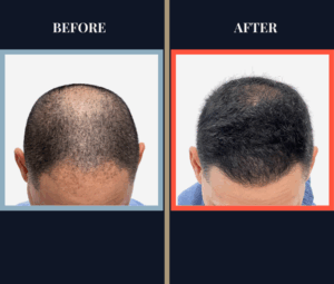 2015 GRAFT FUE HAIR TRANSPLANT RESULTS