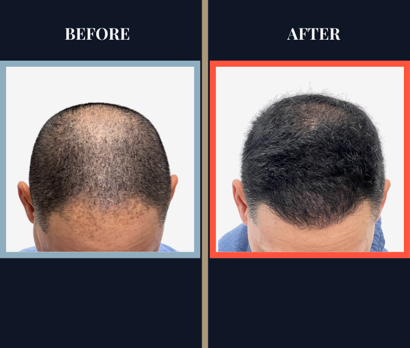 2015 GRAFT FUE HAIR TRANSPLANT RESULTS