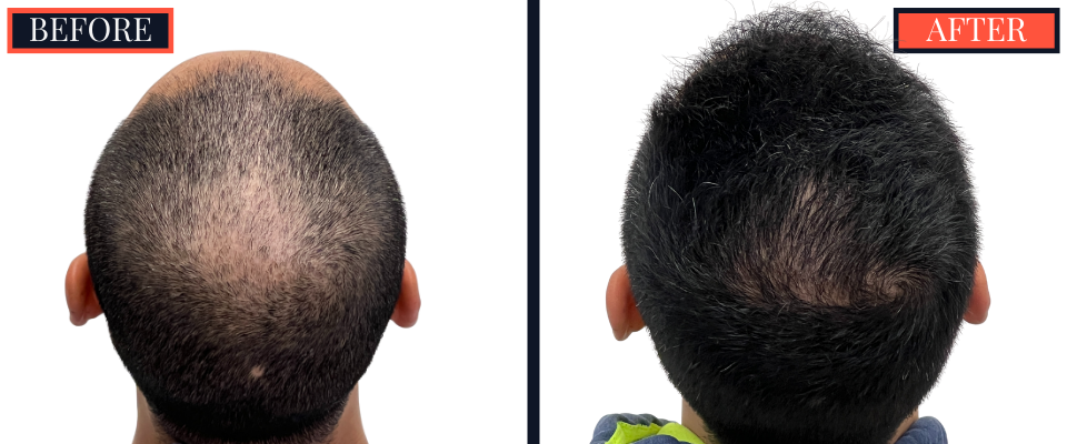 2015 GRAFT FUE HAIR TRANSPLANT RESULTS