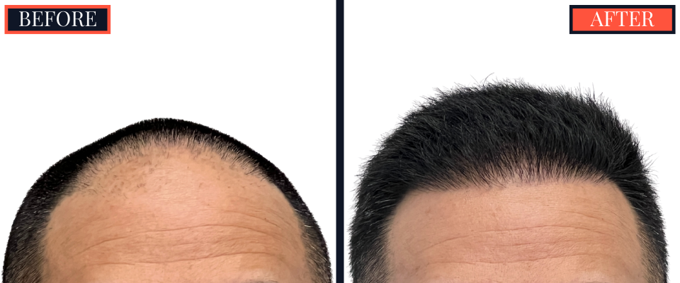 2015 GRAFT FUE HAIR TRANSPLANT RESULTS