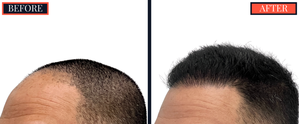 2015 GRAFT FUE HAIR TRANSPLANT RESULTS