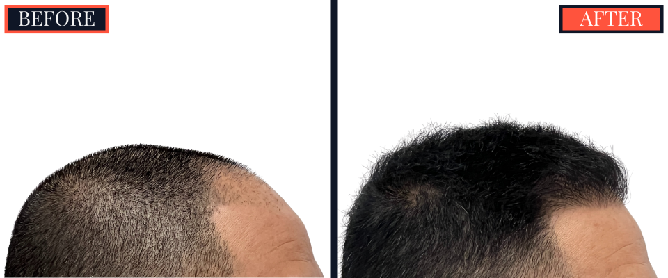 2015 GRAFT FUE HAIR TRANSPLANT RESULTS