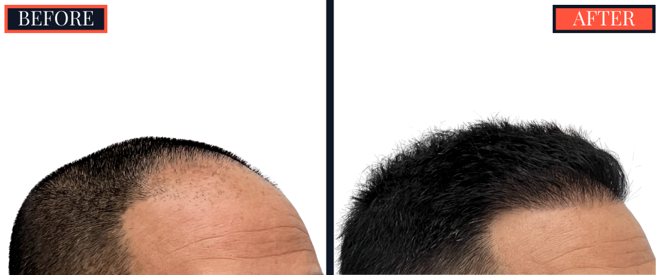 2015 GRAFT FUE HAIR TRANSPLANT RESULTS