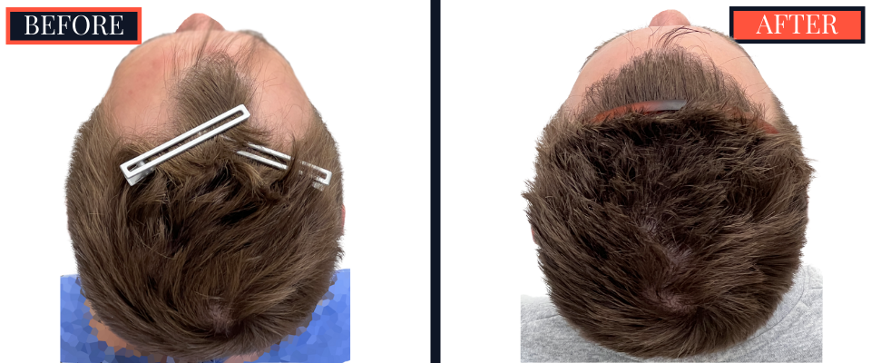 FUE Hair Transplant Results - 1836 Grafts