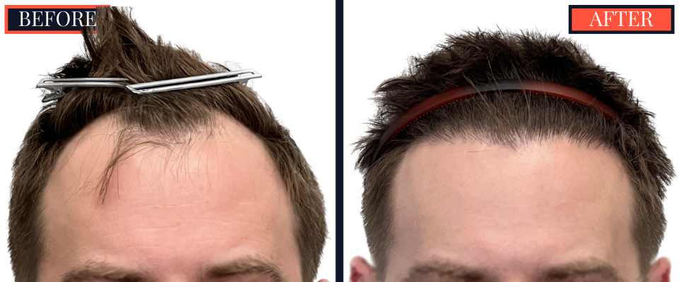 FUE Hair Transplant Results - 1836 Grafts