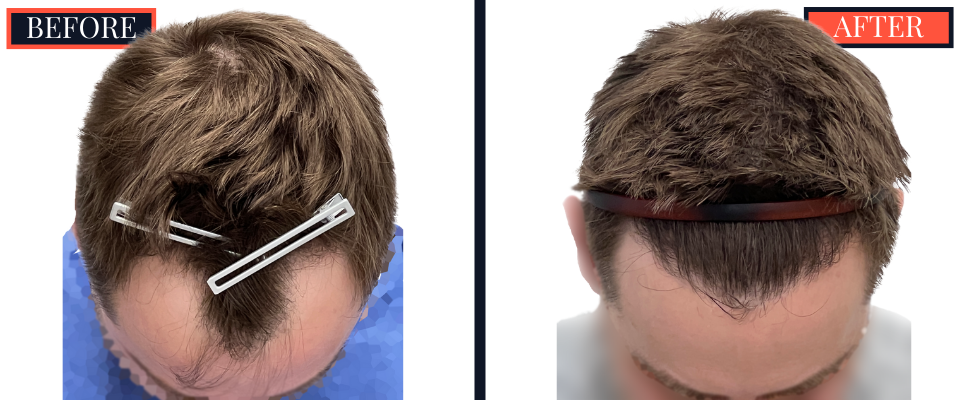 FUE Hair Transplant Results - 1836 Grafts