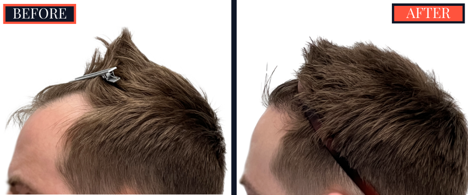 FUE Hair Transplant Results - 1836 Grafts