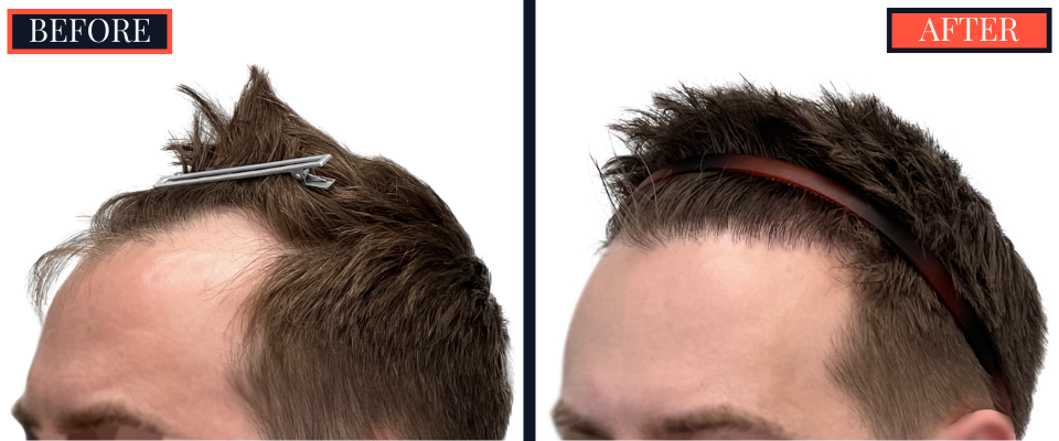 FUE Hair Transplant Results - 1836 Grafts