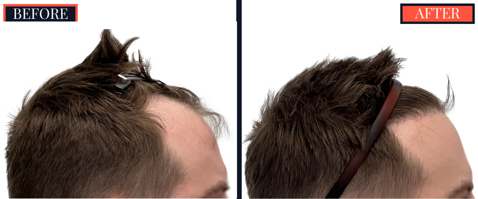 FUE Hair Transplant Results - 1836 Grafts