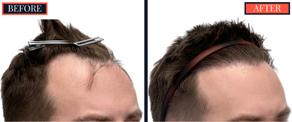 FUE Hair Transplant Results - 1836 Grafts