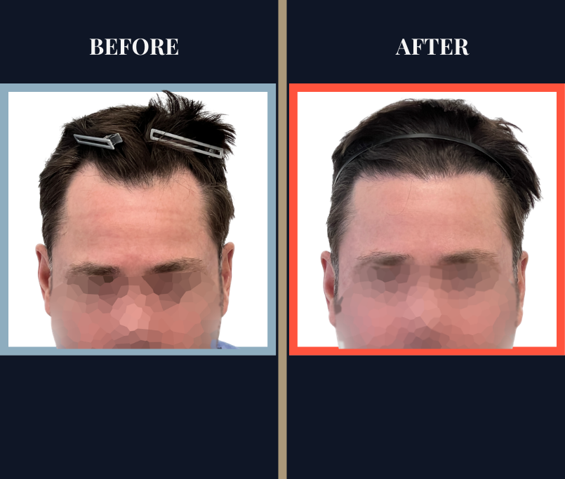 THTS Before and After - 1206 G FUE