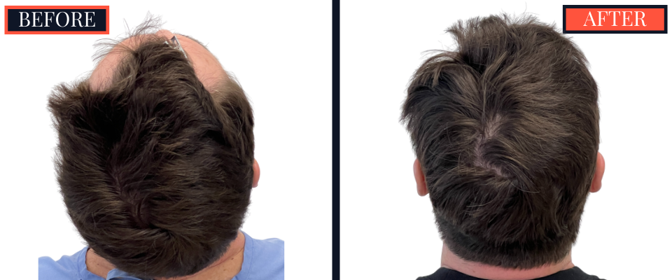 THTS Before and After Results - 1206 G FUE