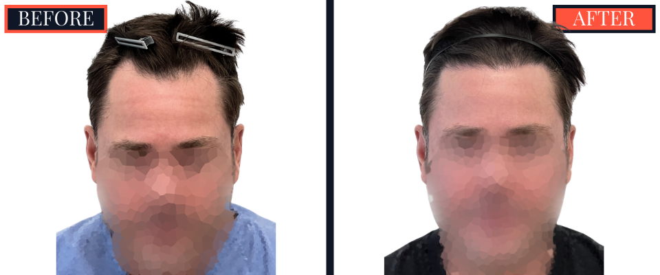 THTS Before and After Results - 1206 G FUE