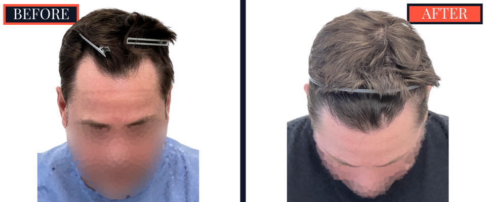 THTS Before and After Results - 1206 G FUE