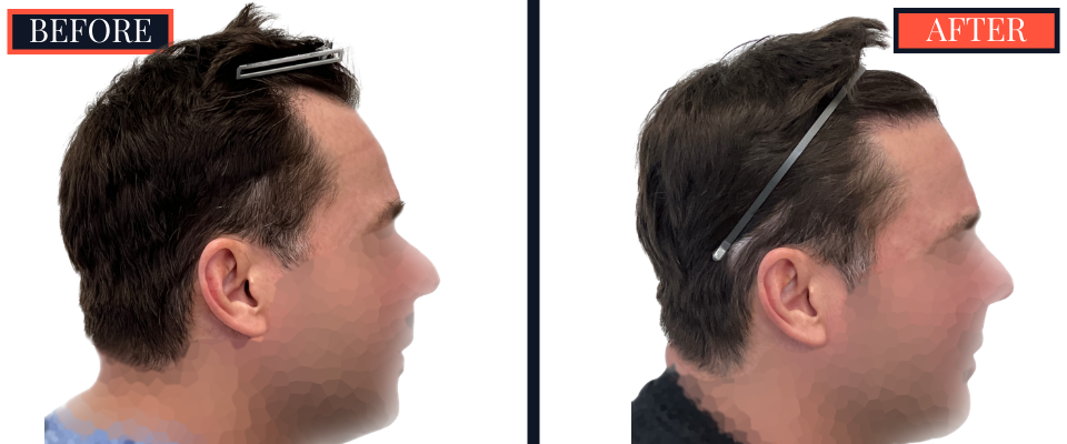 THTS Before and After Results - 1206 G FUE