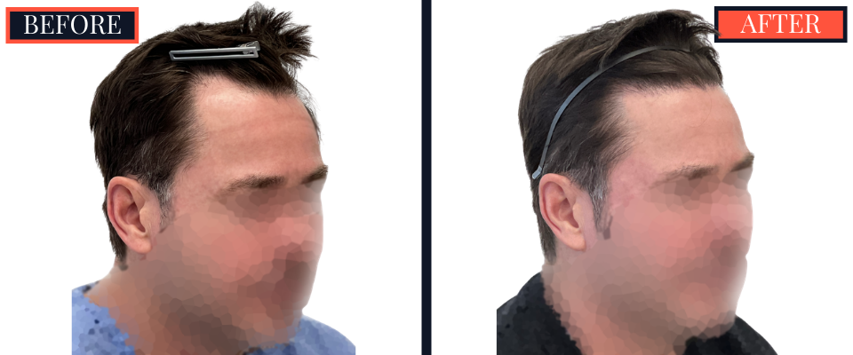 THTS Before and After Results - 1206 G FUE