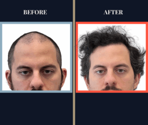 THTS 2051 G FUE Before and After Results