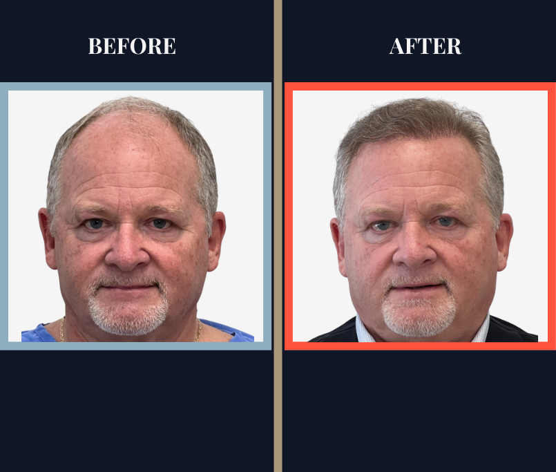 THTS Before and After Results - 2512 Graft FUE