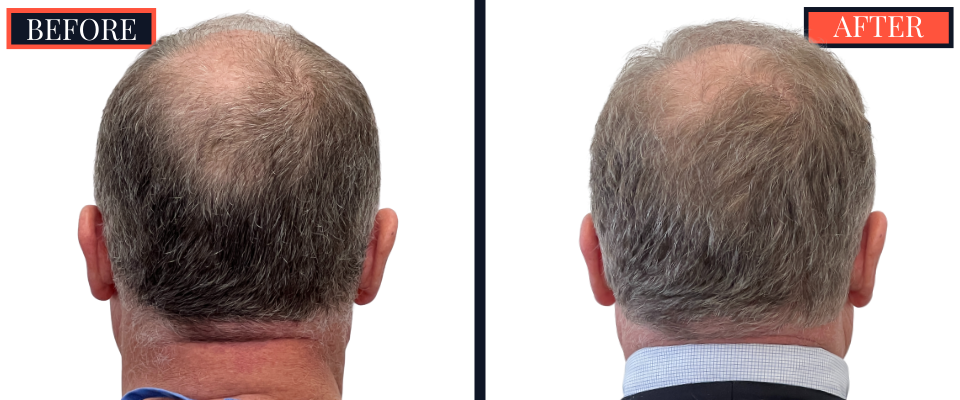 THTS Before and After Results - 2512 Graft FUE
