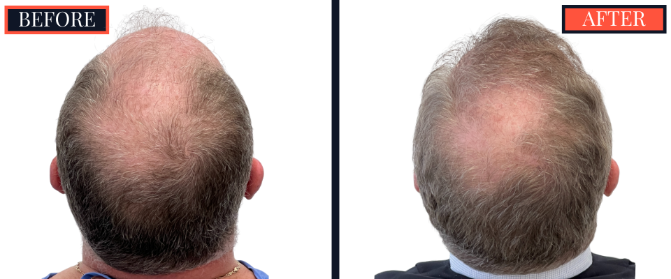 THTS Before and After Results - 2512 Graft FUE