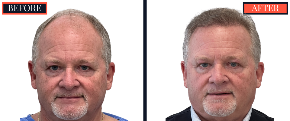 THTS Before and After Results - 2512 Graft FUE