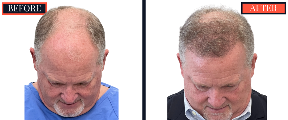 THTS Before and After Results - 2512 Graft FUE