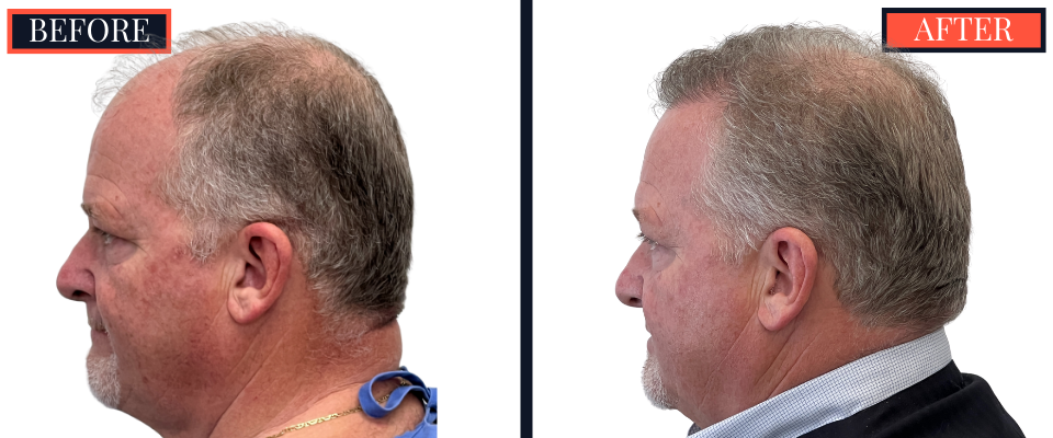 THTS Before and After Results - 2512 Graft FUE