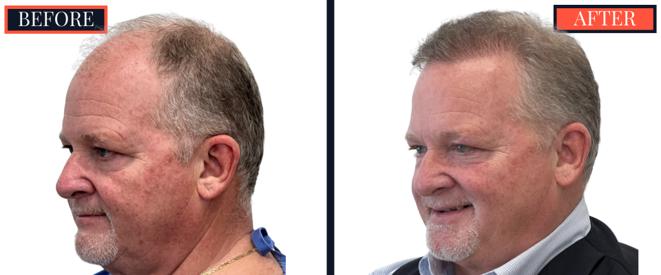 THTS Before and After Results - 2512 Graft FUE