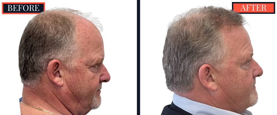 THTS Before and After Results - 2512 Graft FUE