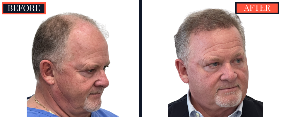 THTS Before and After Results - 2512 Graft FUE