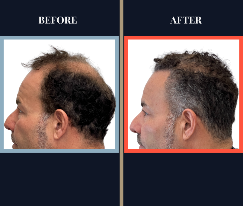 THTS 2872 G FUE BEFORE AND AFTER RESULTS