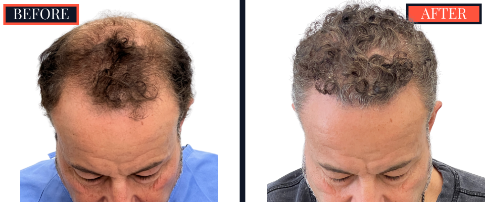 THTS 2872 G FUE BEFORE AND AFTER RESULTS