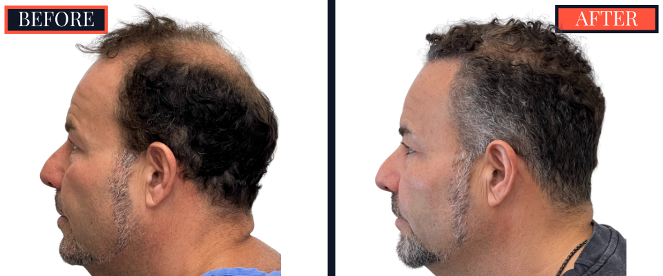 THTS 2872 G FUE BEFORE AND AFTER RESULTS