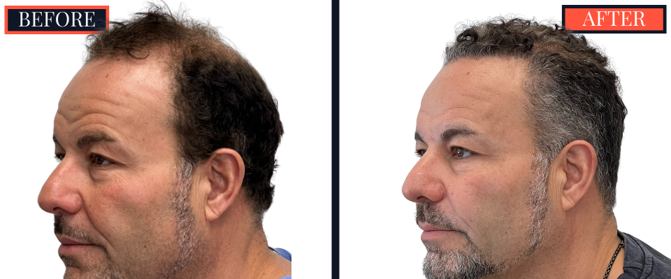 THTS 2872 G FUE BEFORE AND AFTER RESULTS