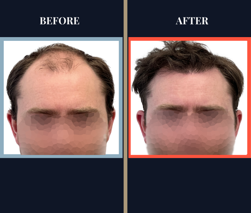 THTS 3001 GRAFT FUE RESULTS