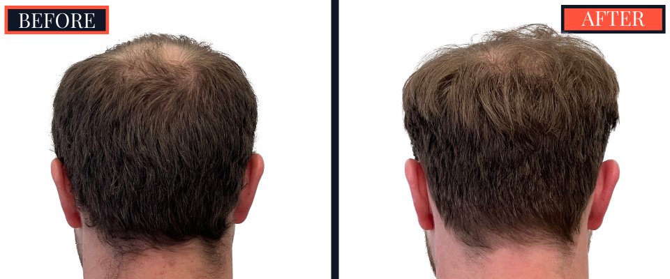 THTS 3001 GRAFT FUE RESULTS