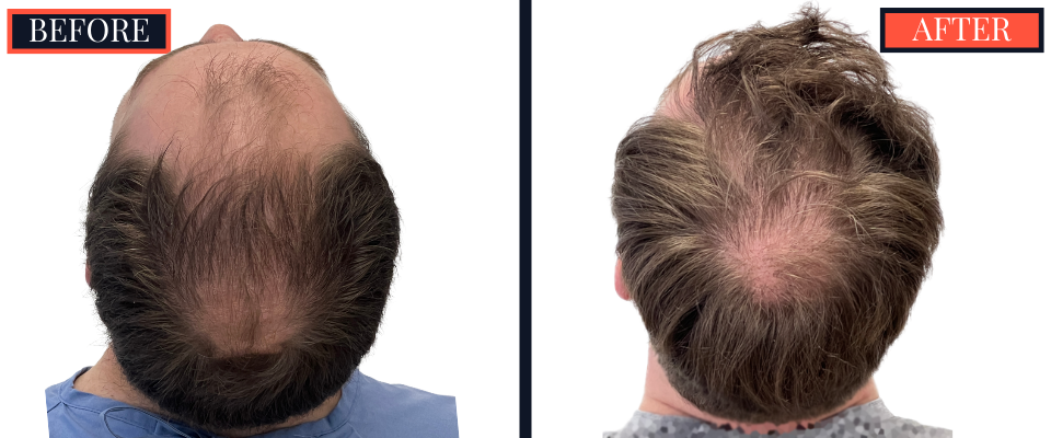 THTS 3001 GRAFT FUE RESULTS