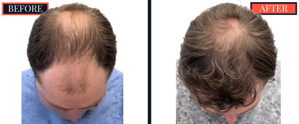 THTS 3001 GRAFT FUE RESULTS