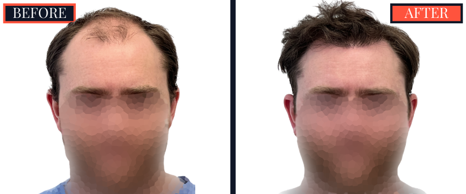 THTS 3001 GRAFT FUE RESULTS