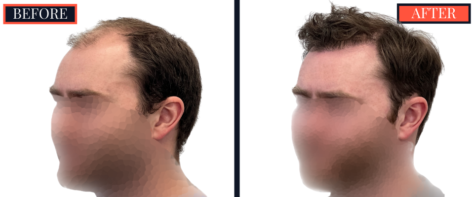 THTS 3001 GRAFT FUE RESULTS