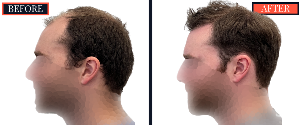 THTS 3001 GRAFT FUE RESULTS