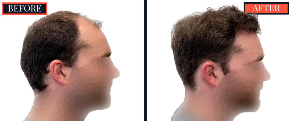 THTS 3001 GRAFT FUE RESULTS