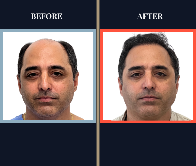 3078 GRAFT STRIP Hair Transplant - THTS RESULTS