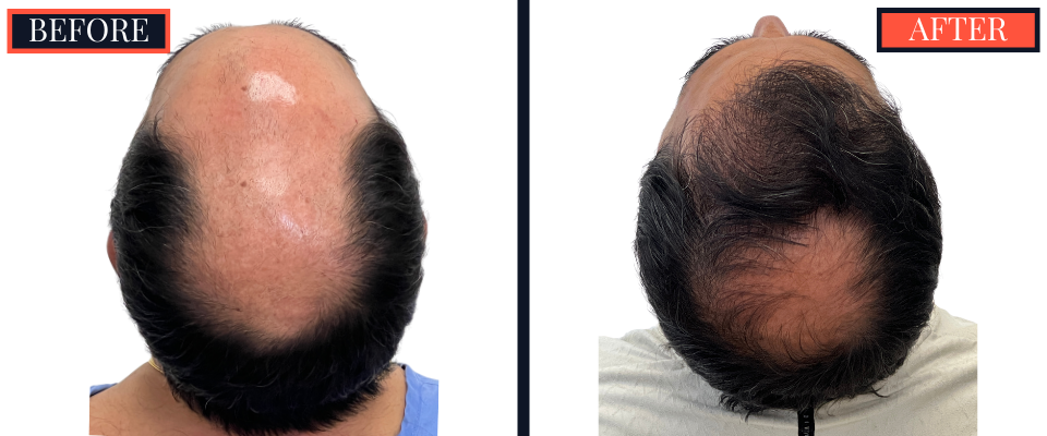 3078 GRAFT STRIP Hair Transplant - THTS RESULTS