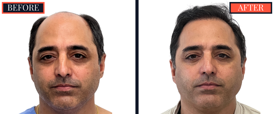 3078 GRAFT STRIP Hair Transplant - THTS RESULTS