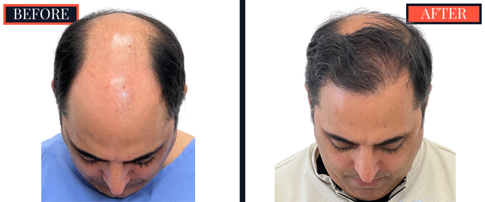 3078 GRAFT STRIP Hair Transplant - THTS RESULTS